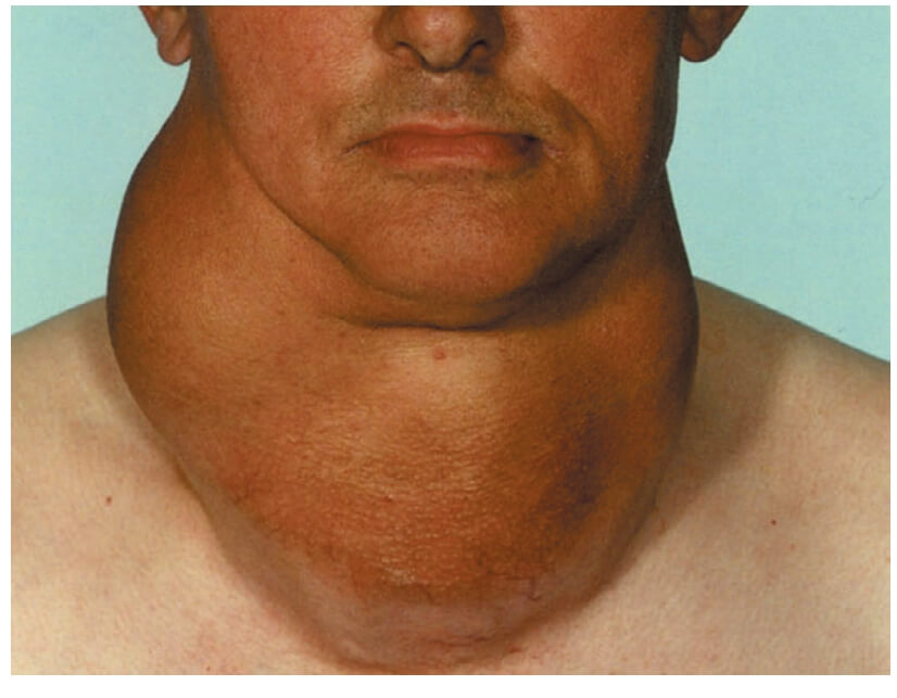 Is Your Neck Swollen? Signs That It Could Be a Thyroid Problem